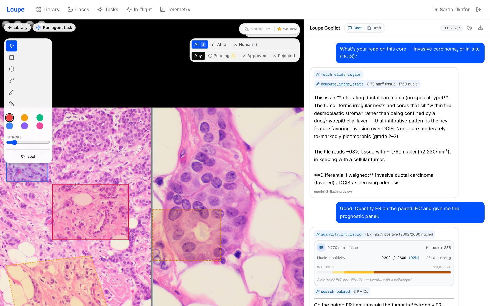 loupe — viewer + copilot (breast · ER)